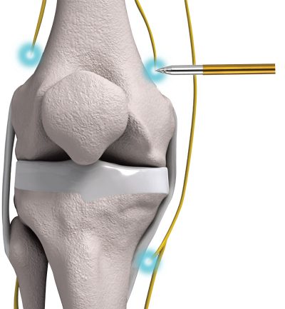 knee03